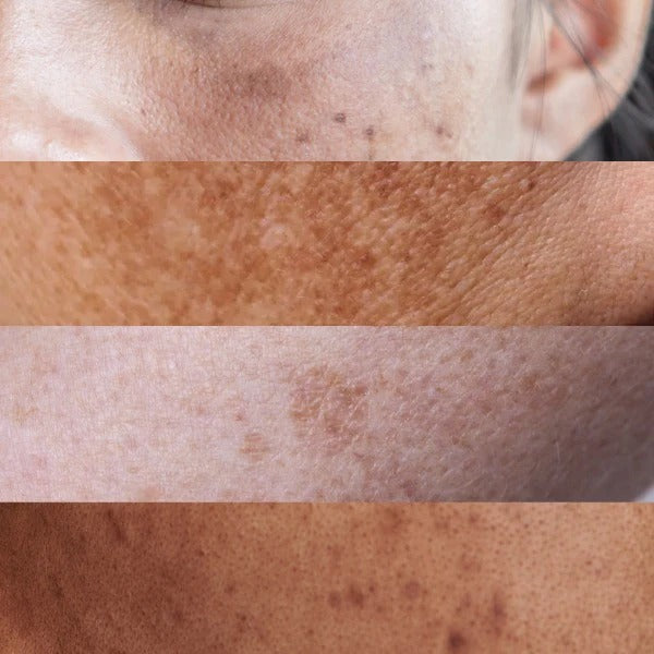 PIGMENTATION