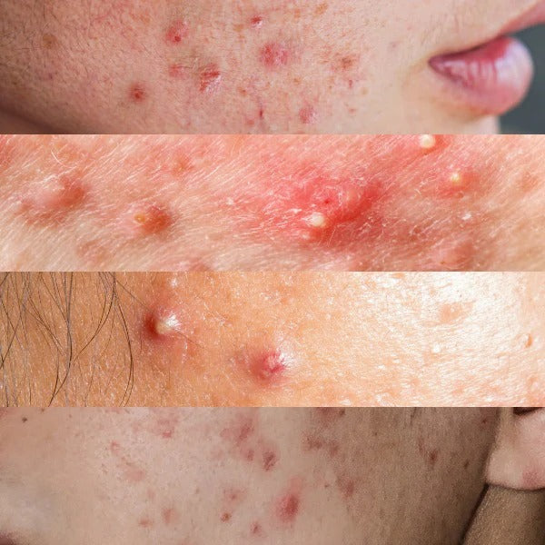 ACNE